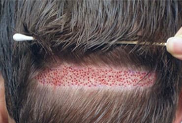 HairFree & HairGrow Follicular Unit Extraction 