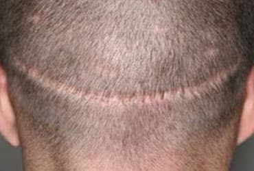 HairFree & HairGrow Strip Harvesting 