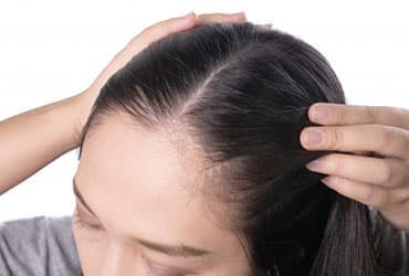 Failed* Hair Transplant Repair 