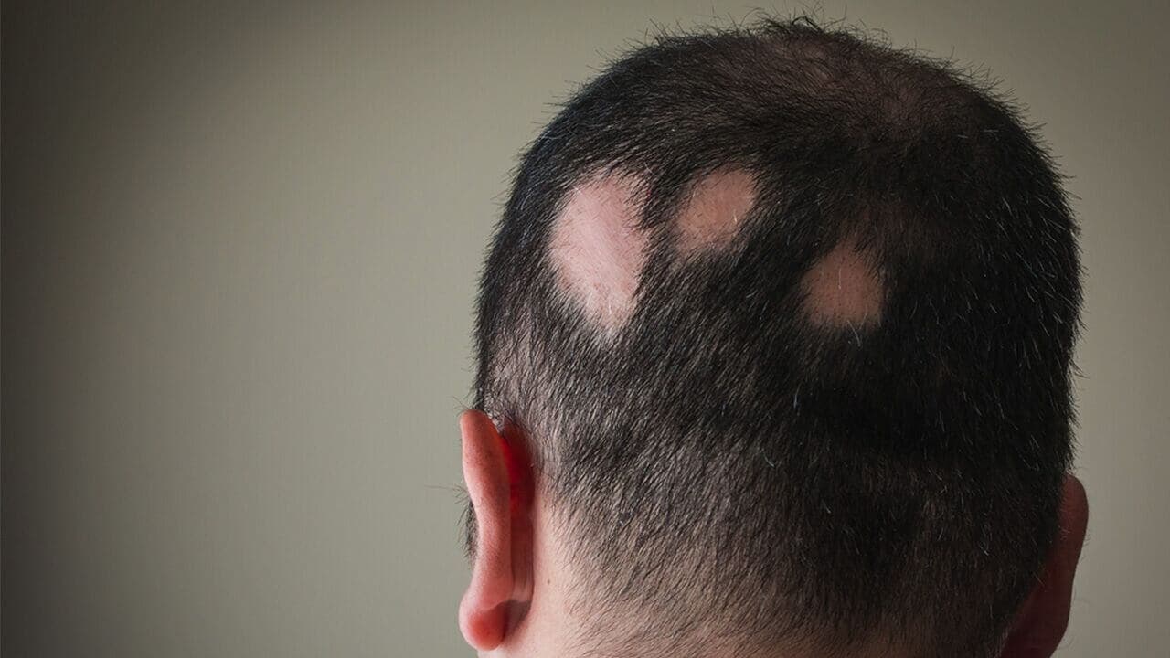 Alopecia-areata