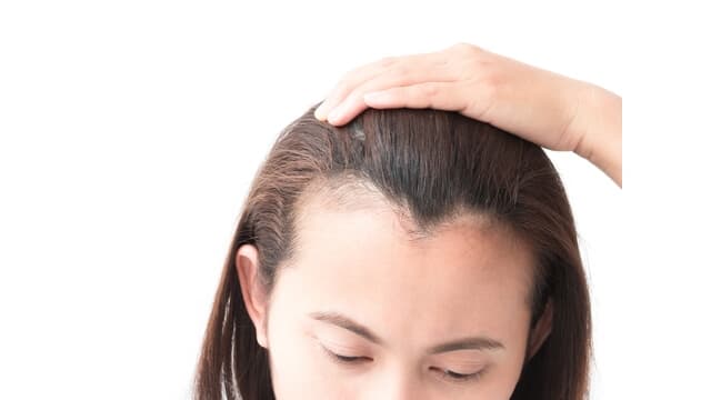 hair loss before family function