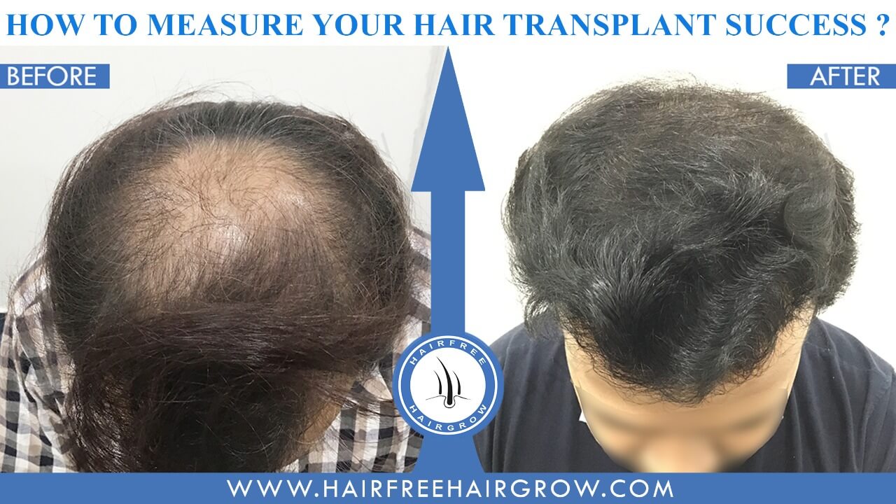 how to measure hair transplant success
