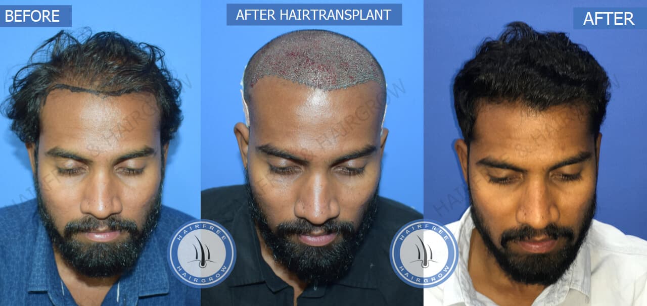 Best Hair Transplant Result