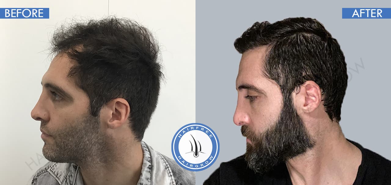 Before and After Hair Transplant Surgery