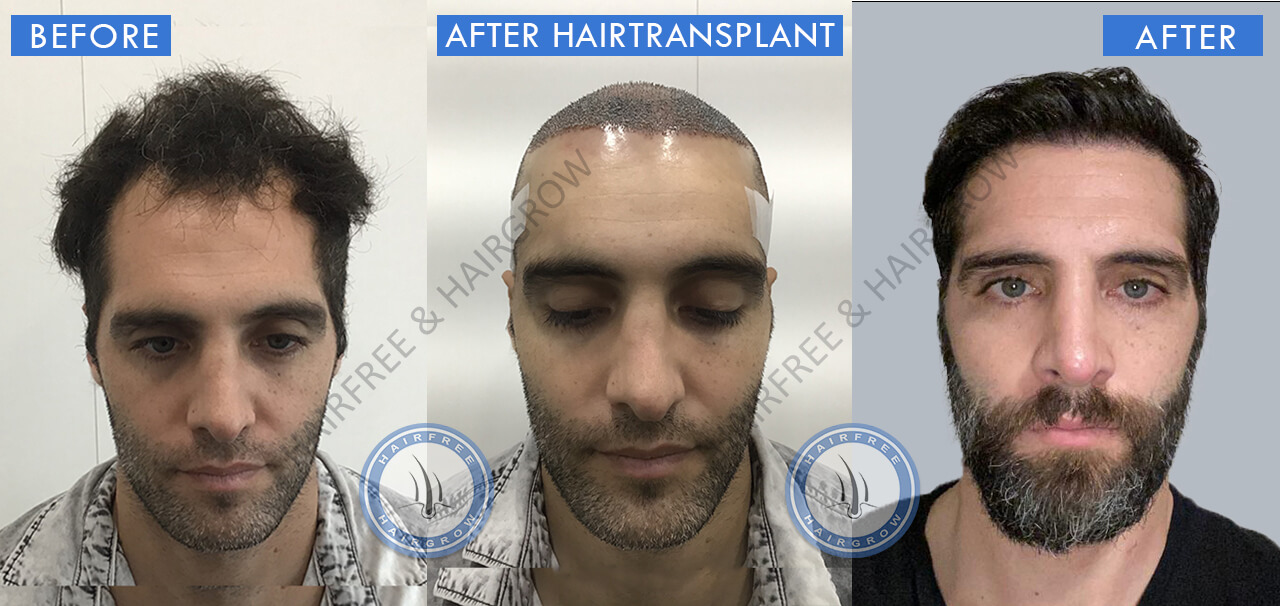 Hair Transplant Result