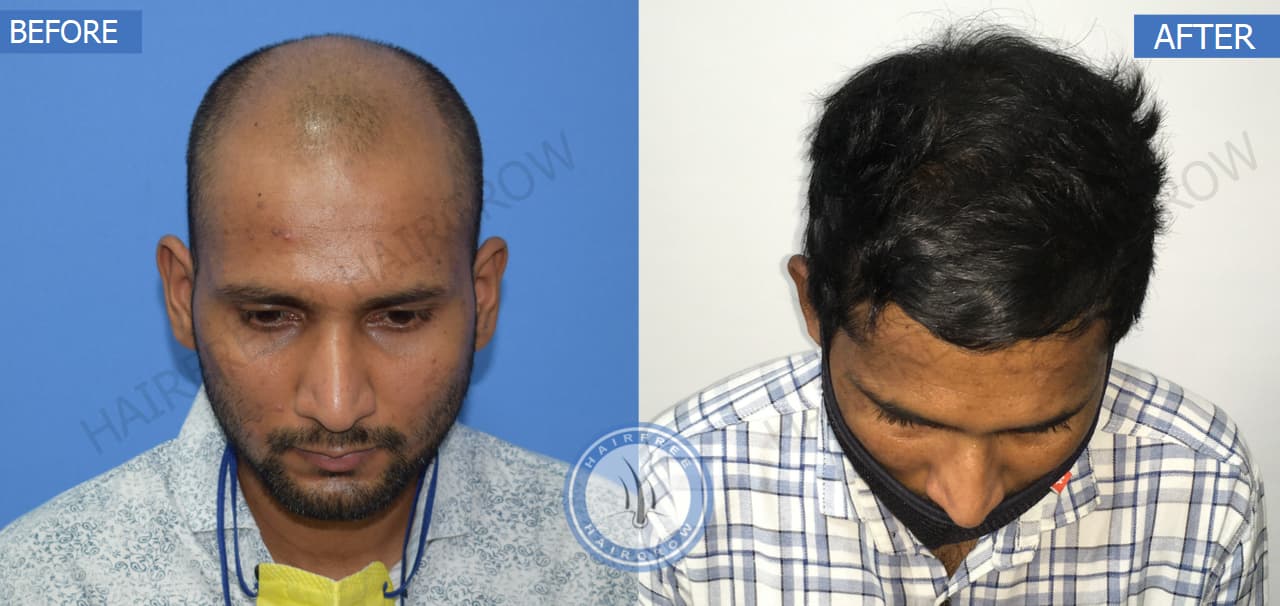 Before and After Hair Transplant Surgery