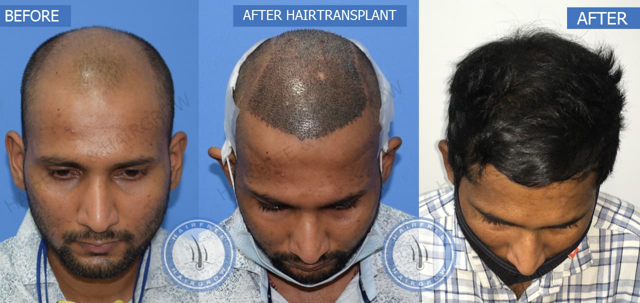 Hair Transplant Result