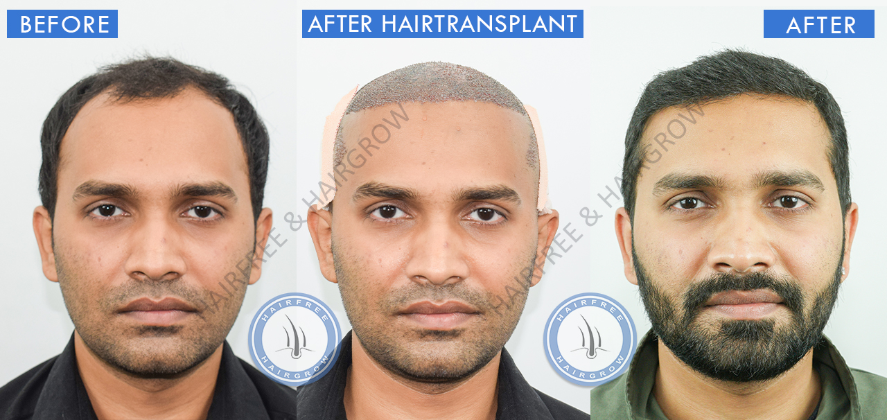 Best Hair Transplant Result
