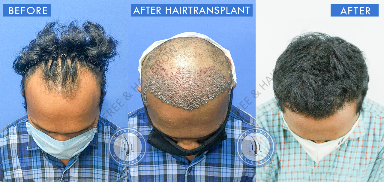 Hair Transplant Result
