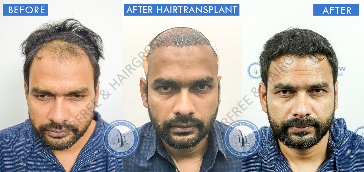 Best Hair Transplant Result