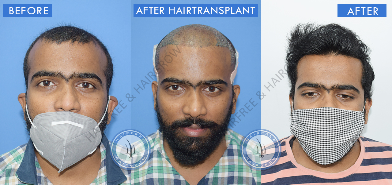 Hair Transplant Result