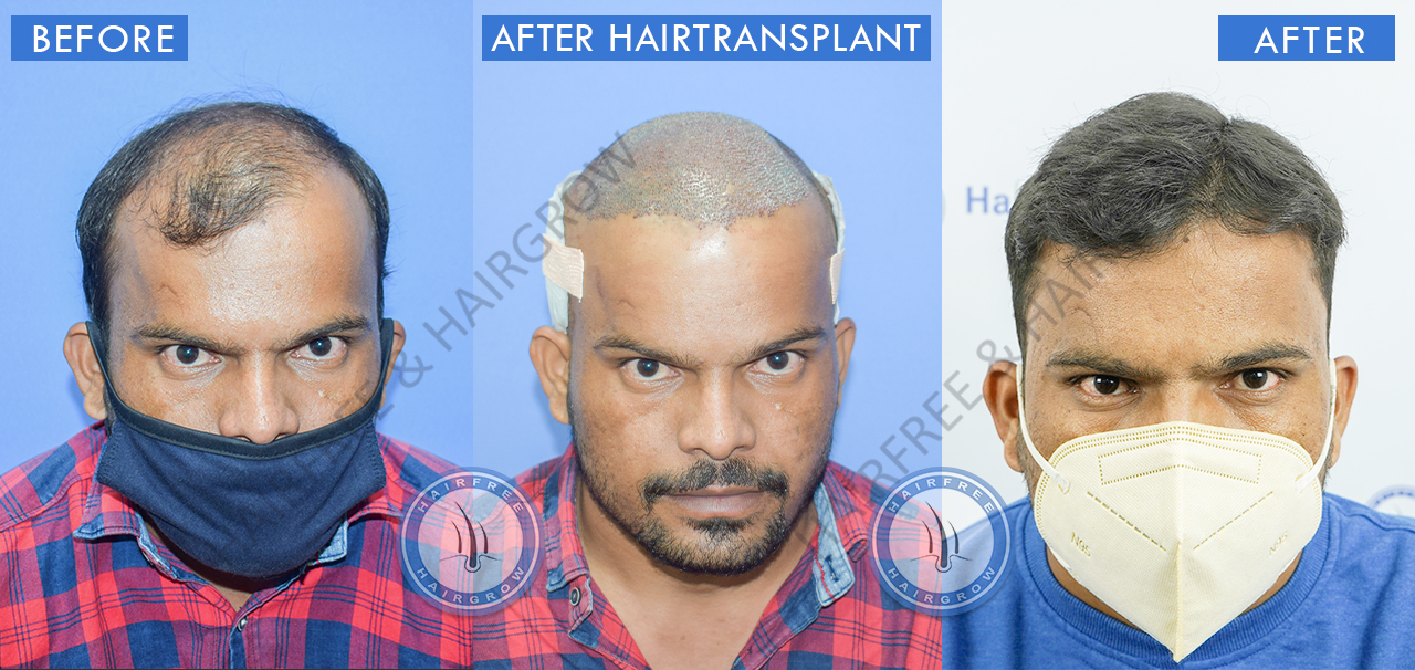Best Hair Transplant Result