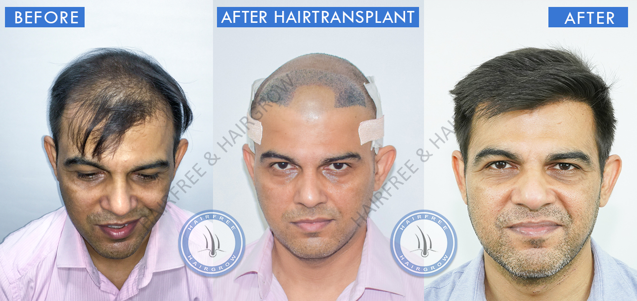 Hair Transplant Result