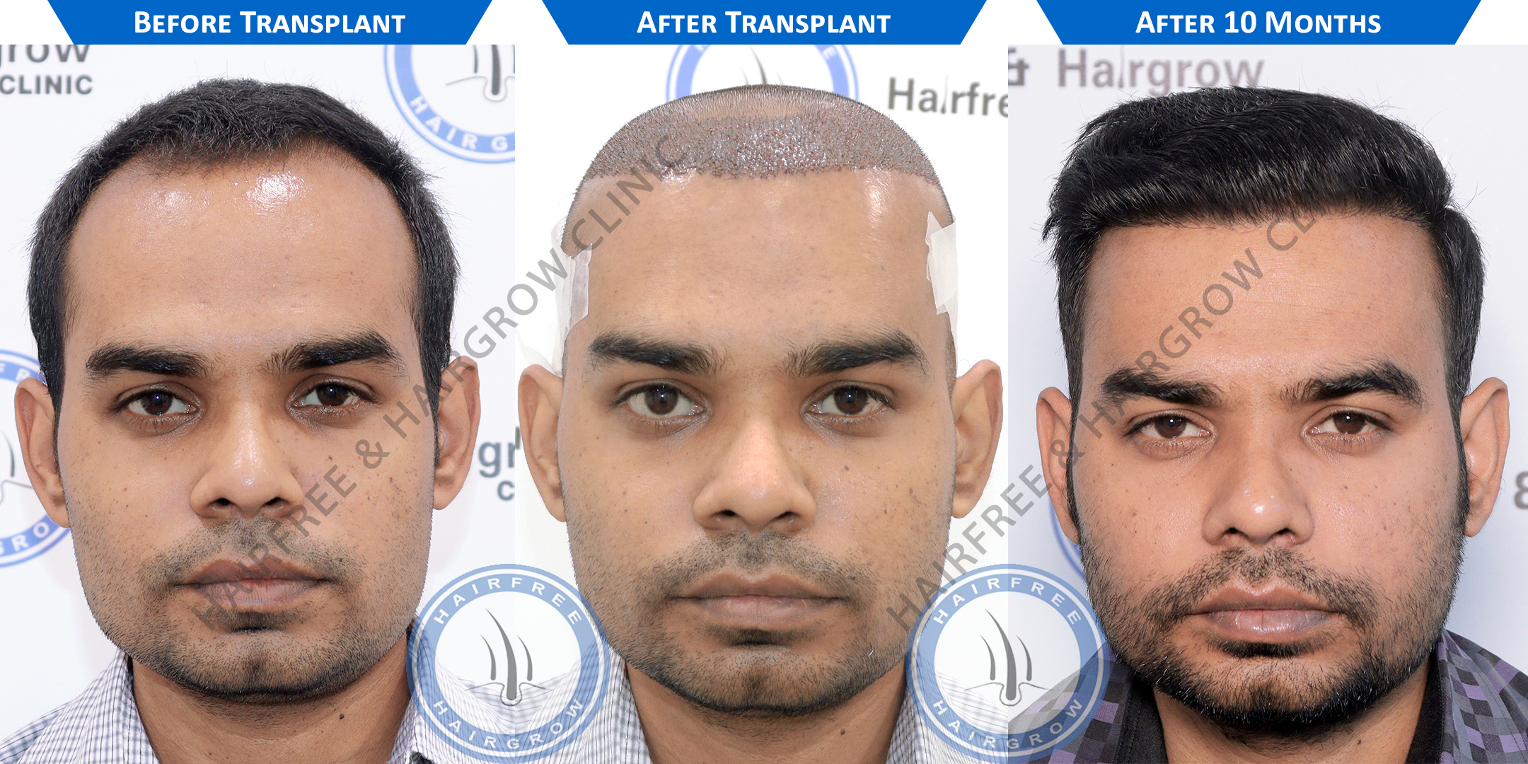 Best Hair Transplant Result