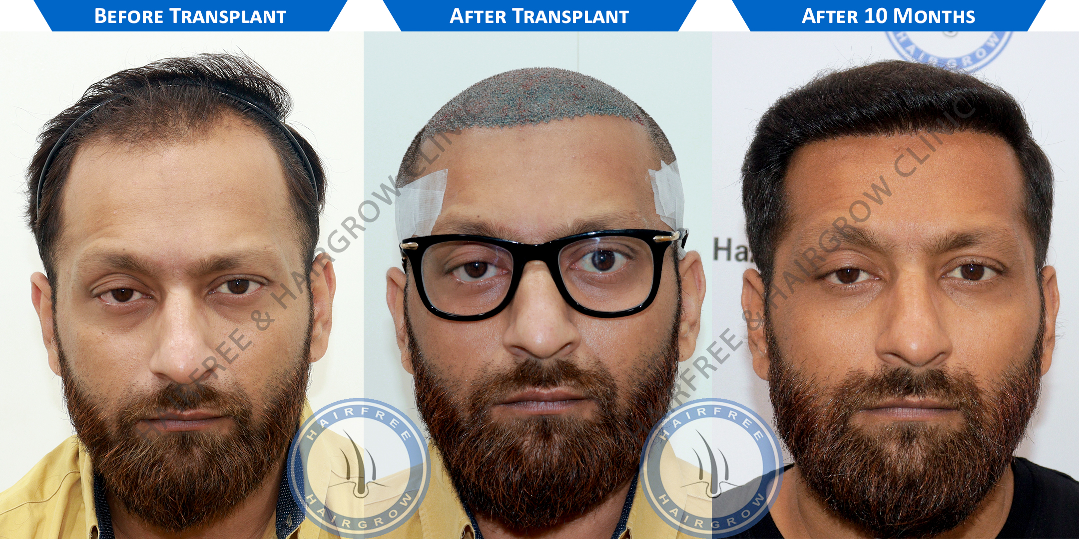 Hair Transplant Result