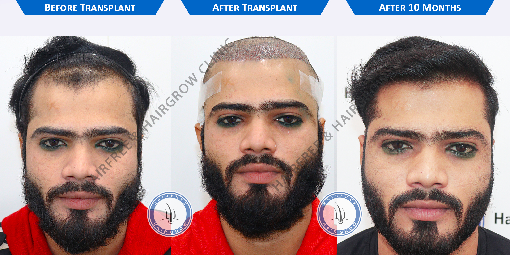 Best Hair Transplant Result