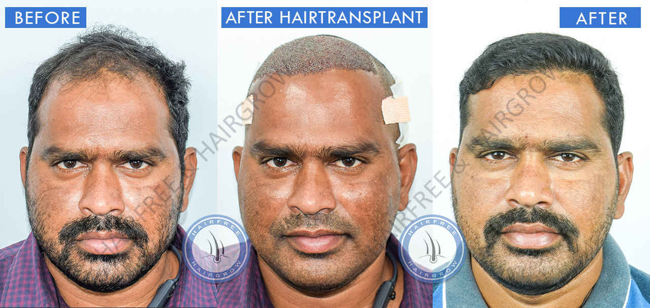 Hair Transplant Result