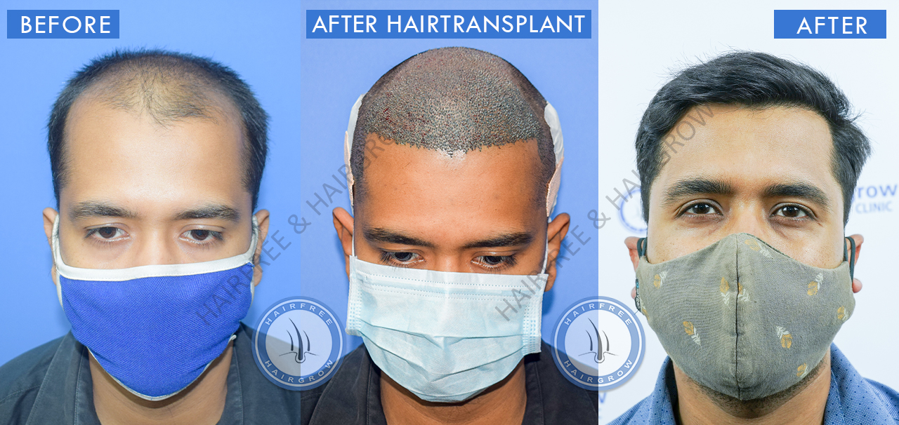 Best Hair Transplant Result