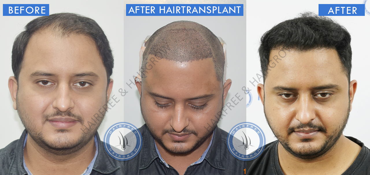 Hair Transplant Result