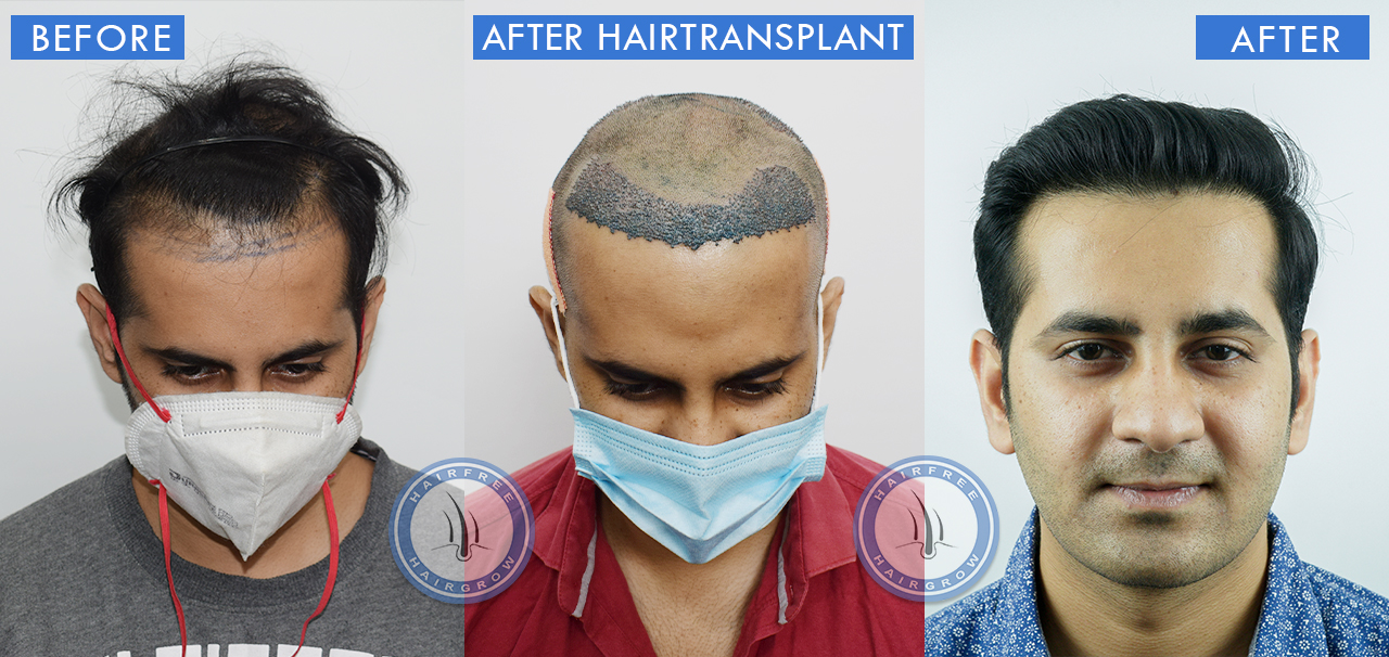 Hair Transplant Result
