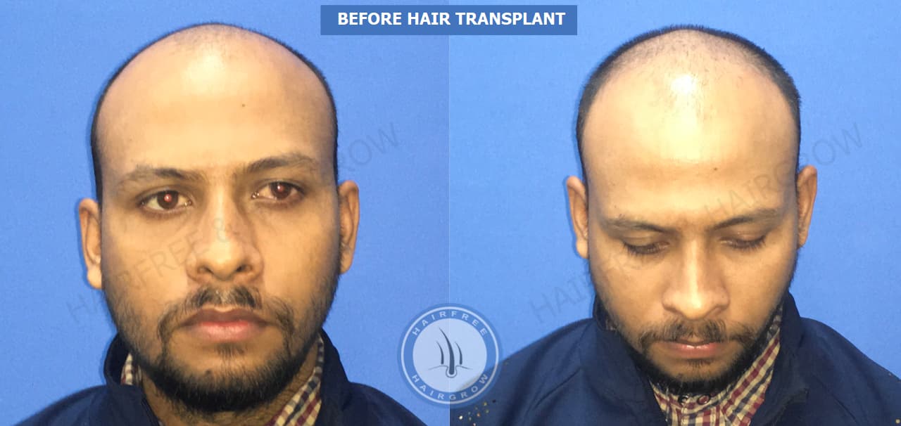 Before Hair Transplant 