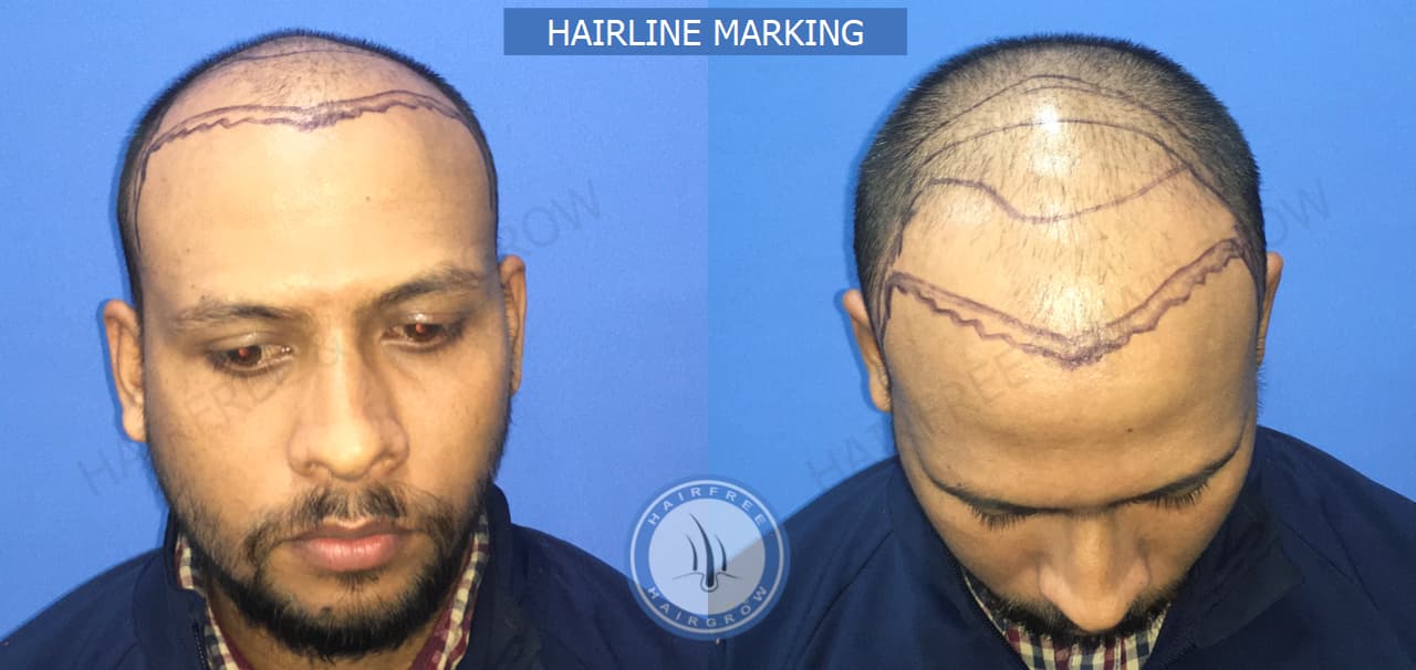 Hairline Marking 