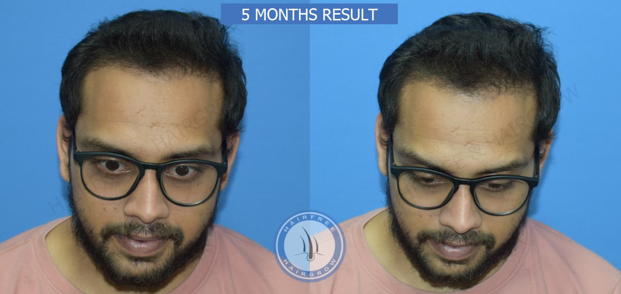 5 Months Results 