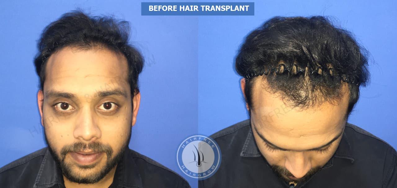 Before Hair Transplant 