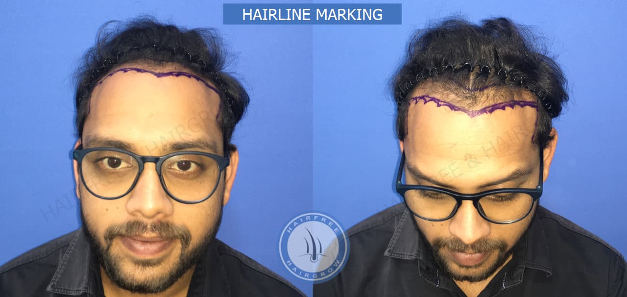 Hairline Marking 