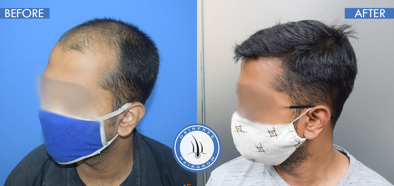 Before and After Hair Transplant Surgery