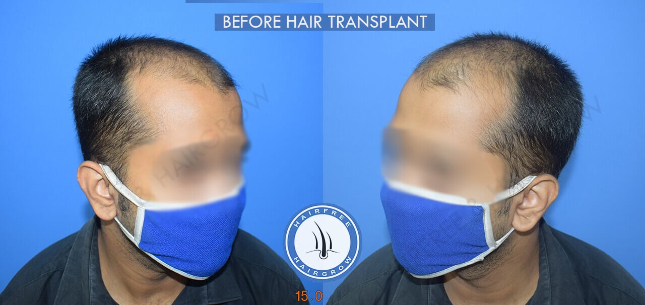 Before Hair Transplant 