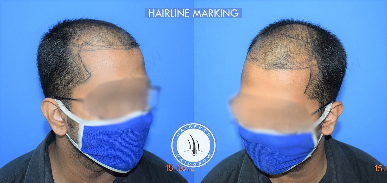 Hairline Marking 