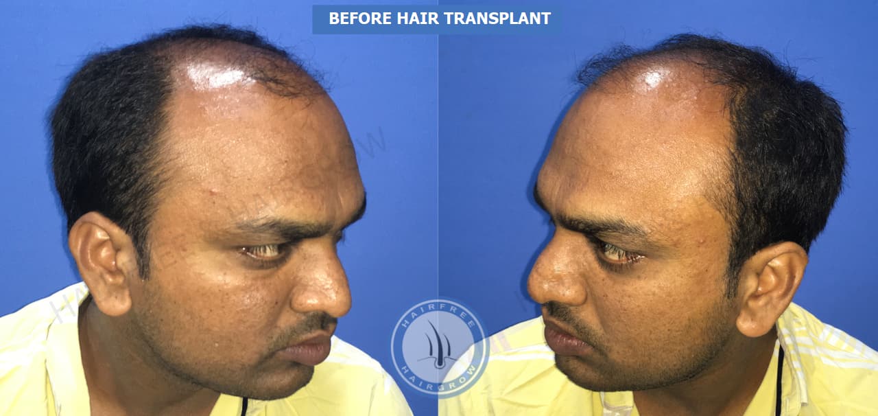Before Hair Transplant 