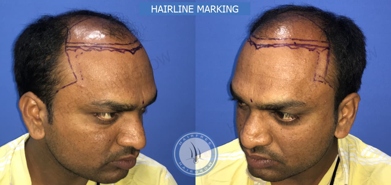 Hairline Marking 