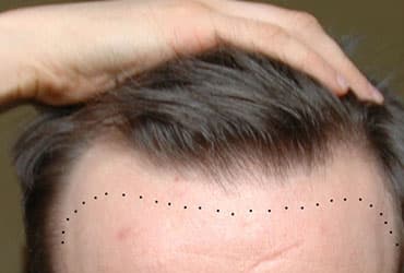 HairFree & HairGrow Hairline Transplant 