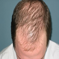 hair loss