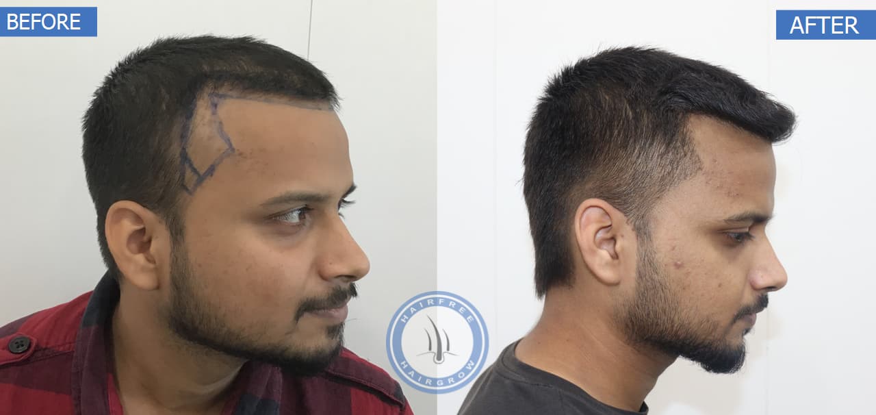 Before and After - Left View