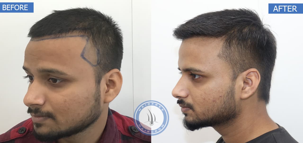 Before and After - Right View